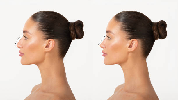 Rhinoplasty in Riyadh