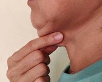 Double Chin Removal in Abu Dhabi